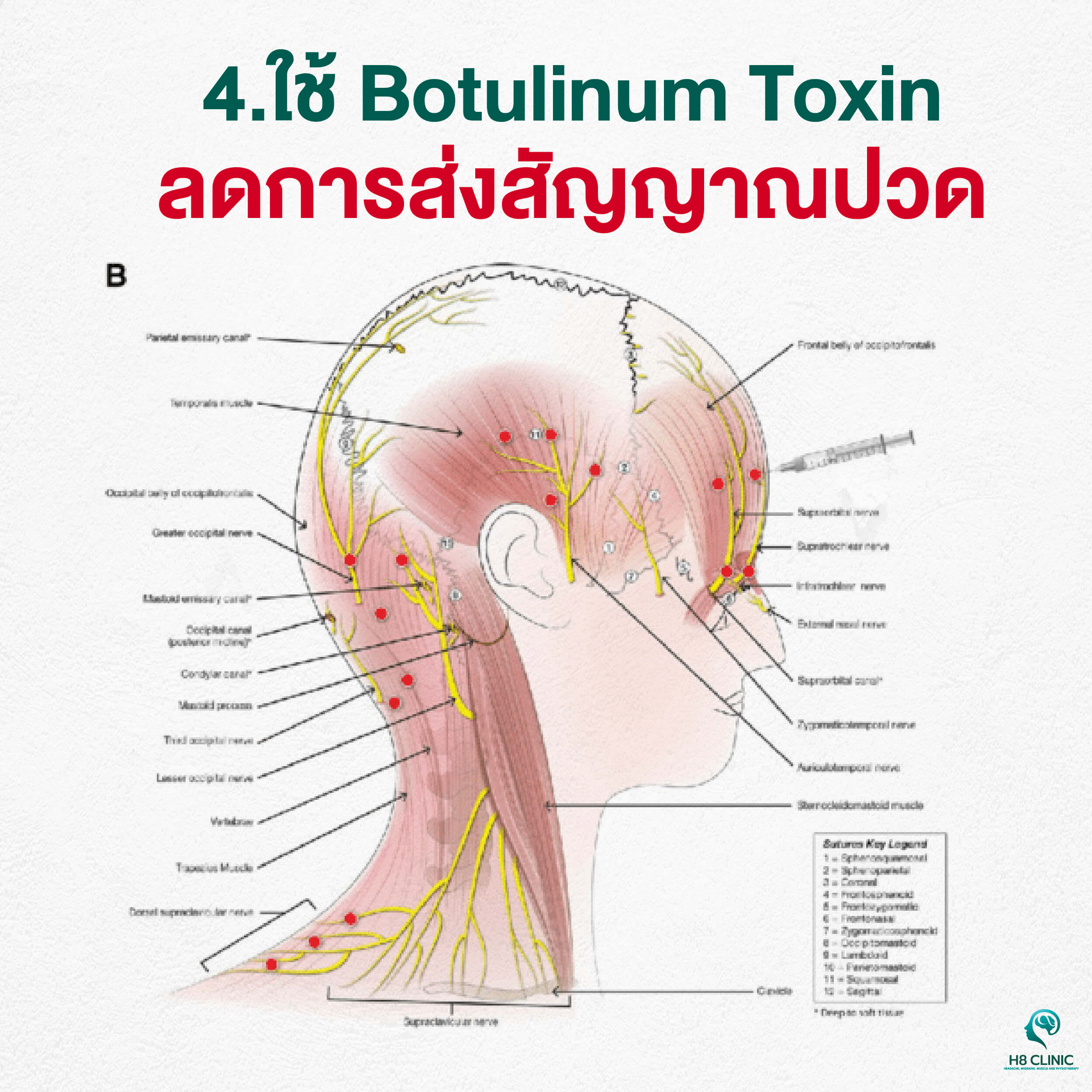 ใช้ Botulinum Toxin