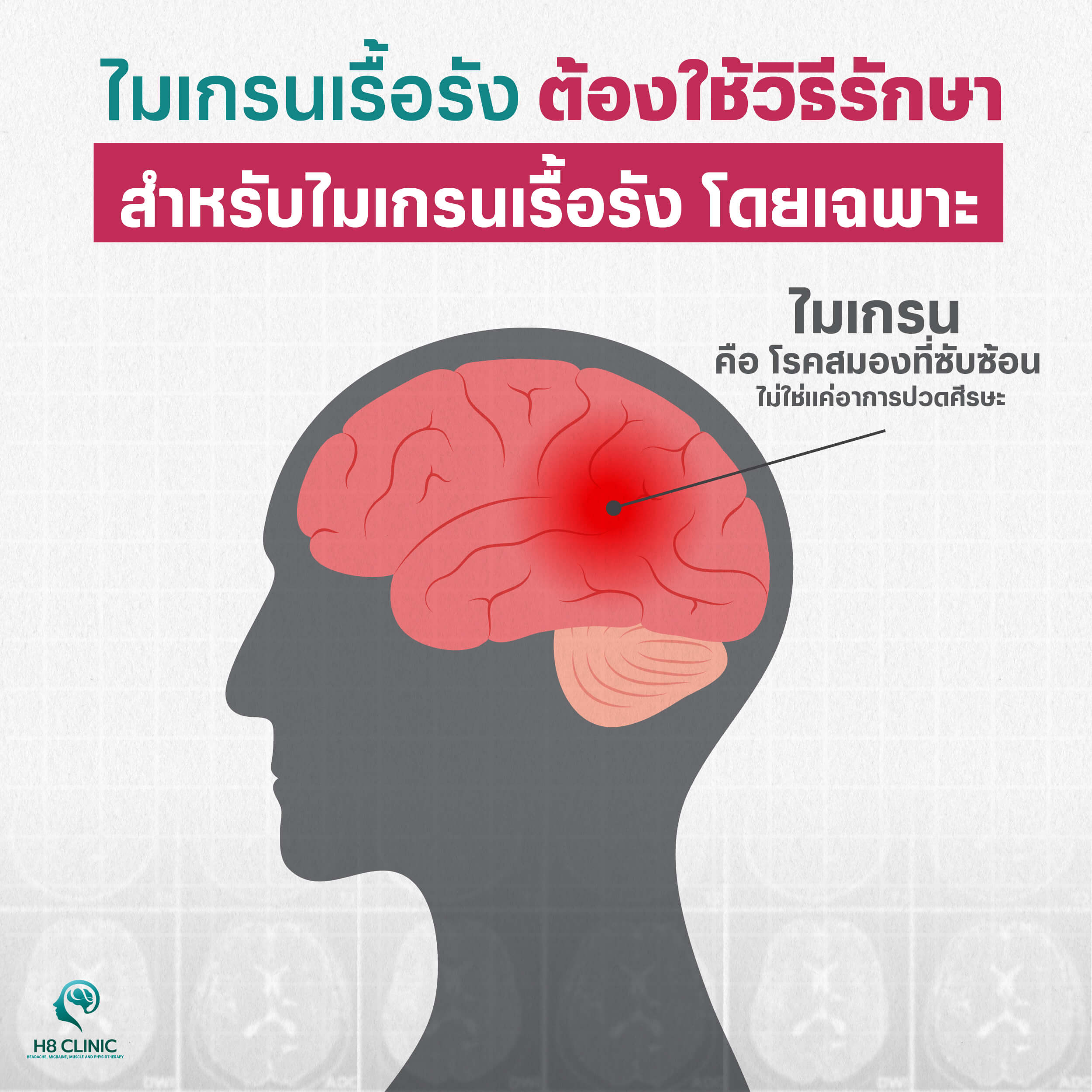 ไมเกรนเรื้อรังรักษายังไง ?