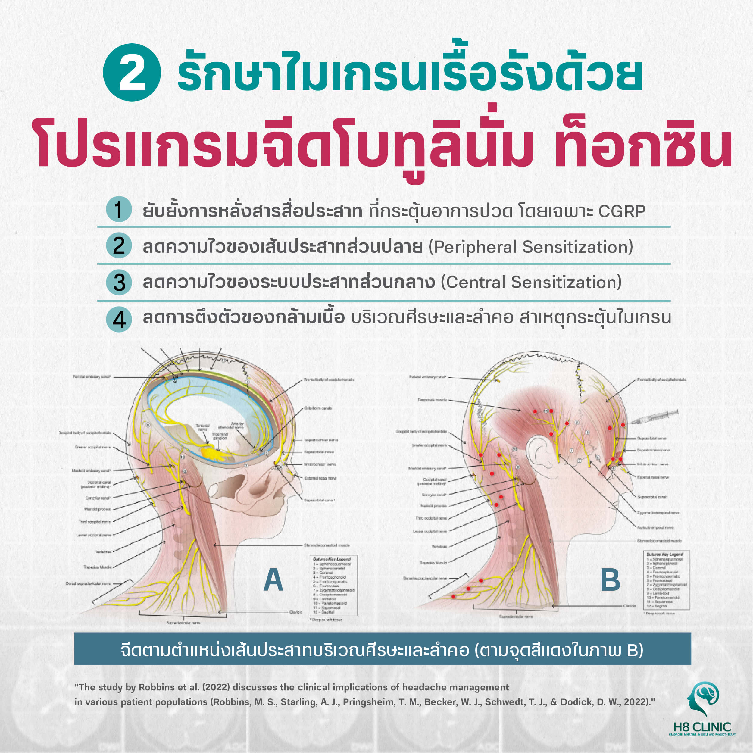 ฉีดโบทูลินั่ม ท็อกซิน เอ รักษาไมเกรน