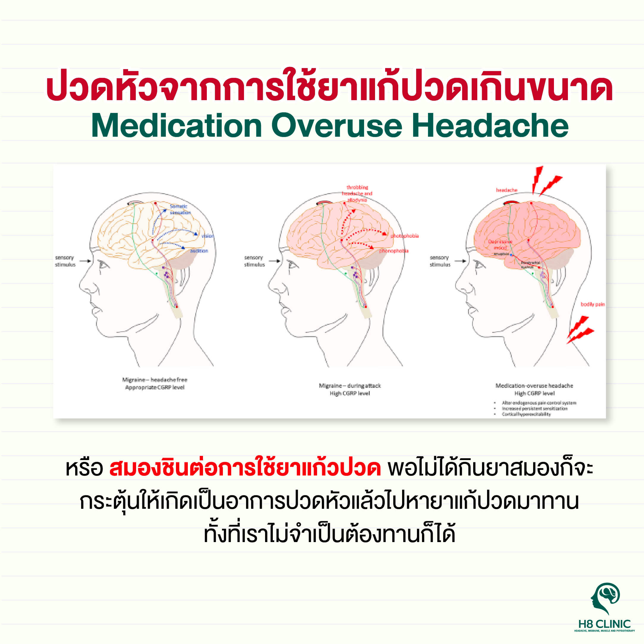 ภาวะสมองติดยาแก้ปวด หรือ Medication Overuse Headaches