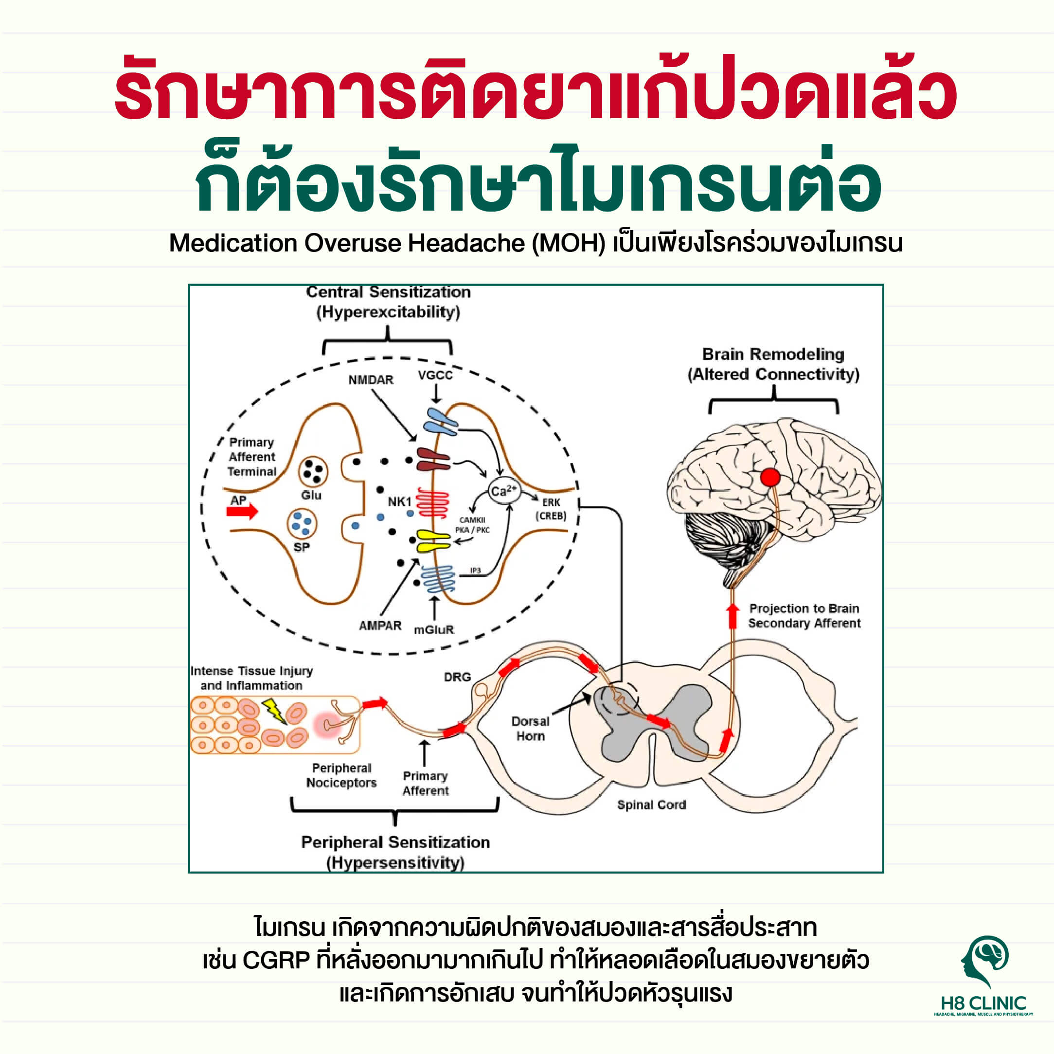 รักษาการติดยาแก้ปวดแล้ว ก็ต้องรักษาไมเกรนต่อ
