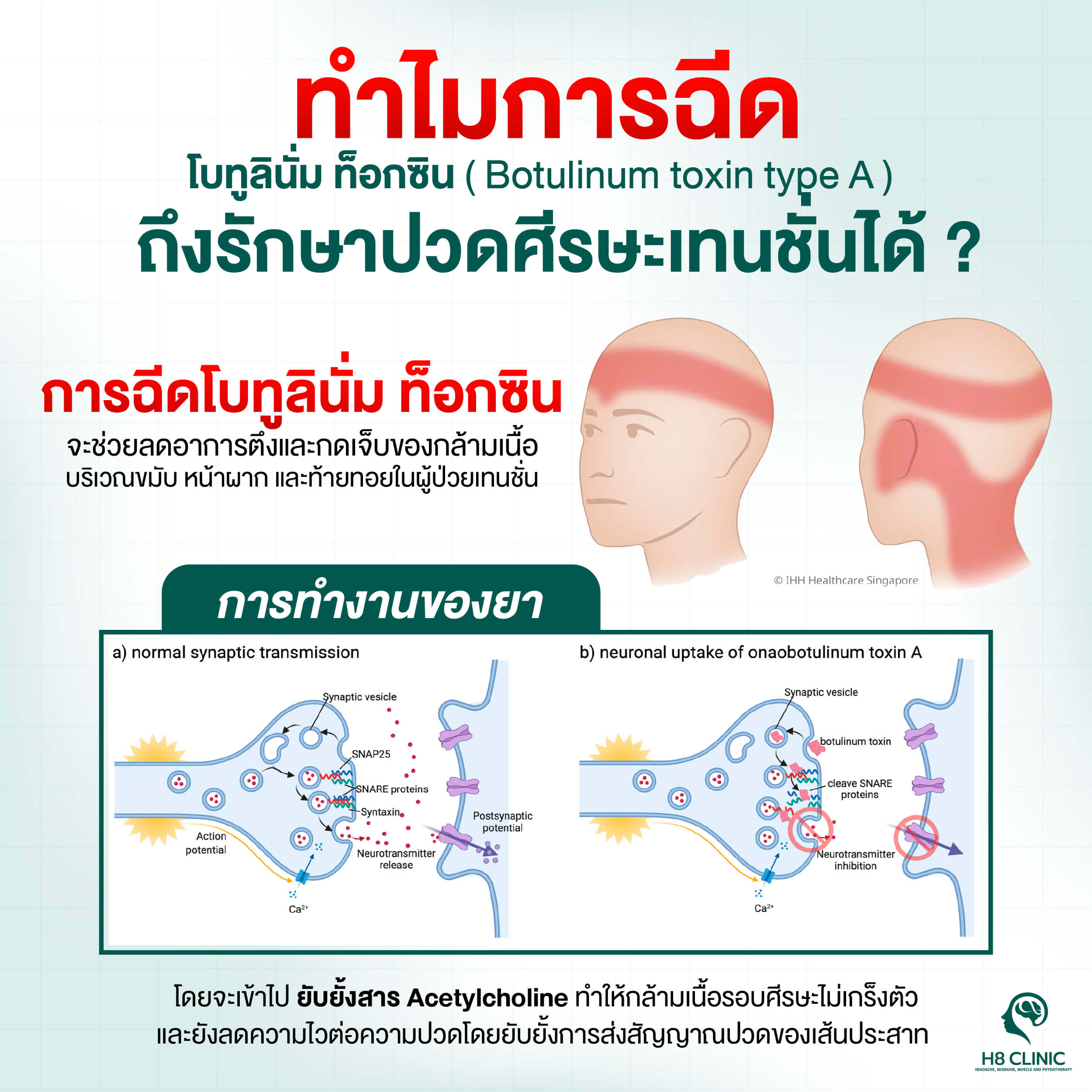 ปวดหัวเทนชั่น