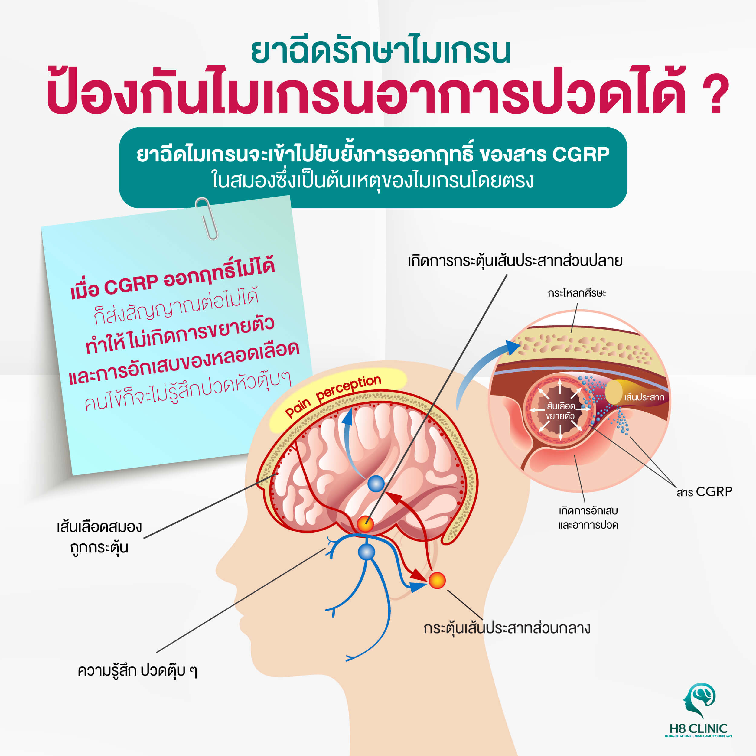 ยาฉีดไมเกรนคืออะไร