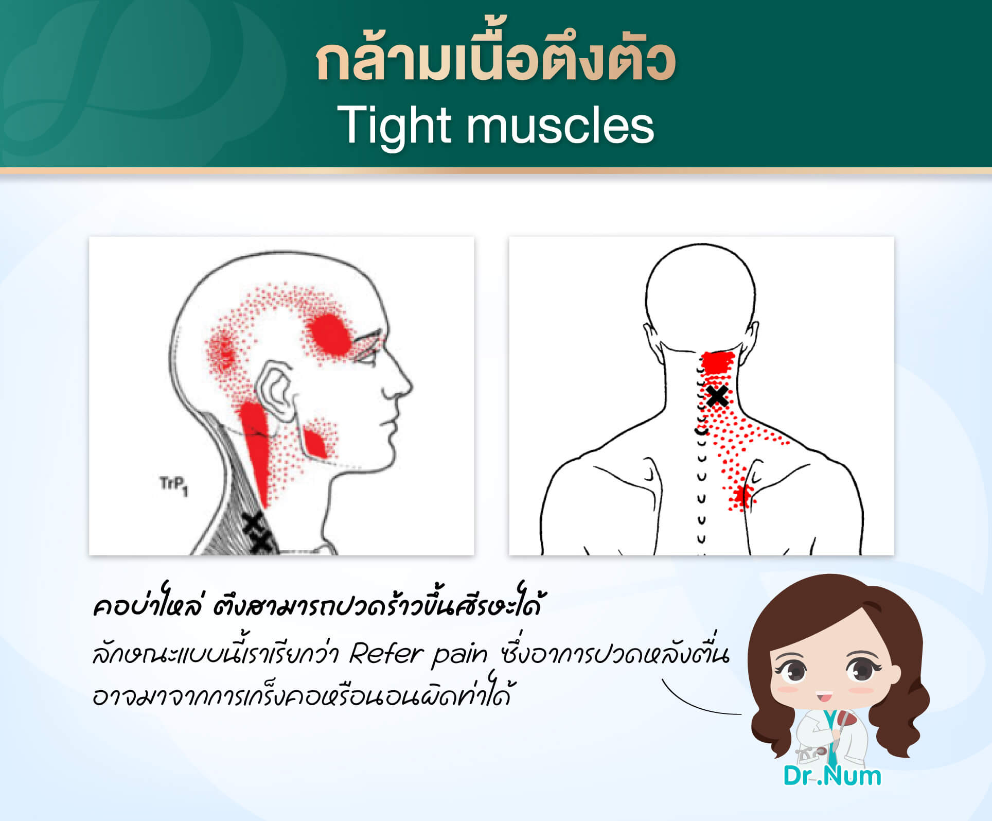 3.กล้ามเนื้อตึงตัว