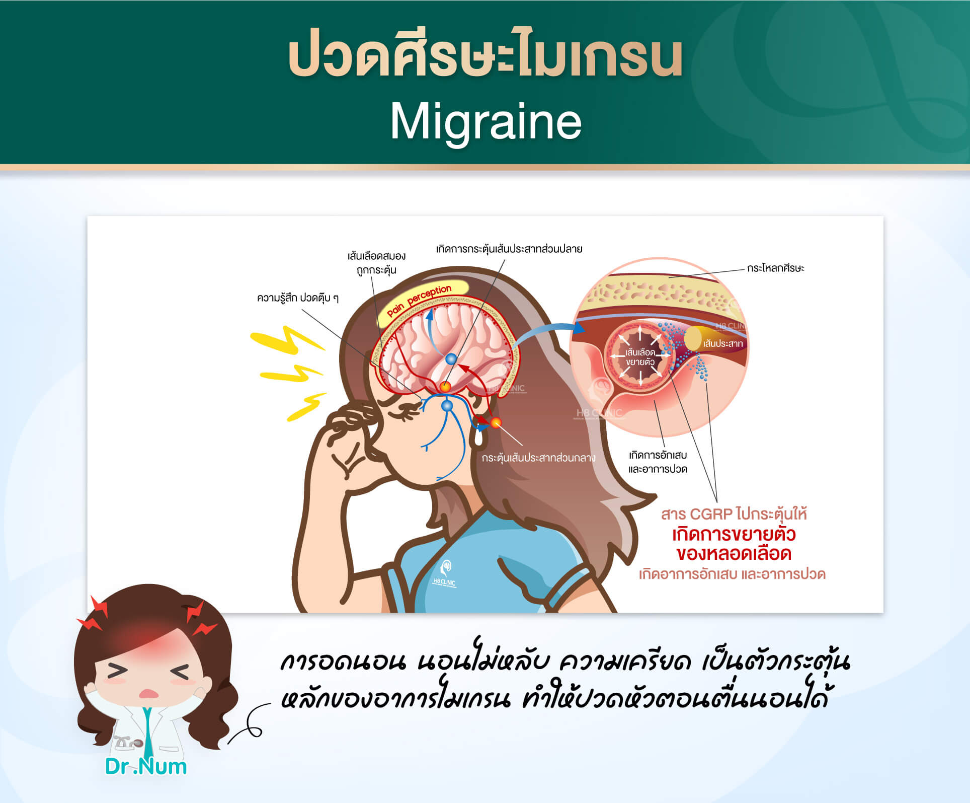 2.โรคปวดศีรษะไมเกรน