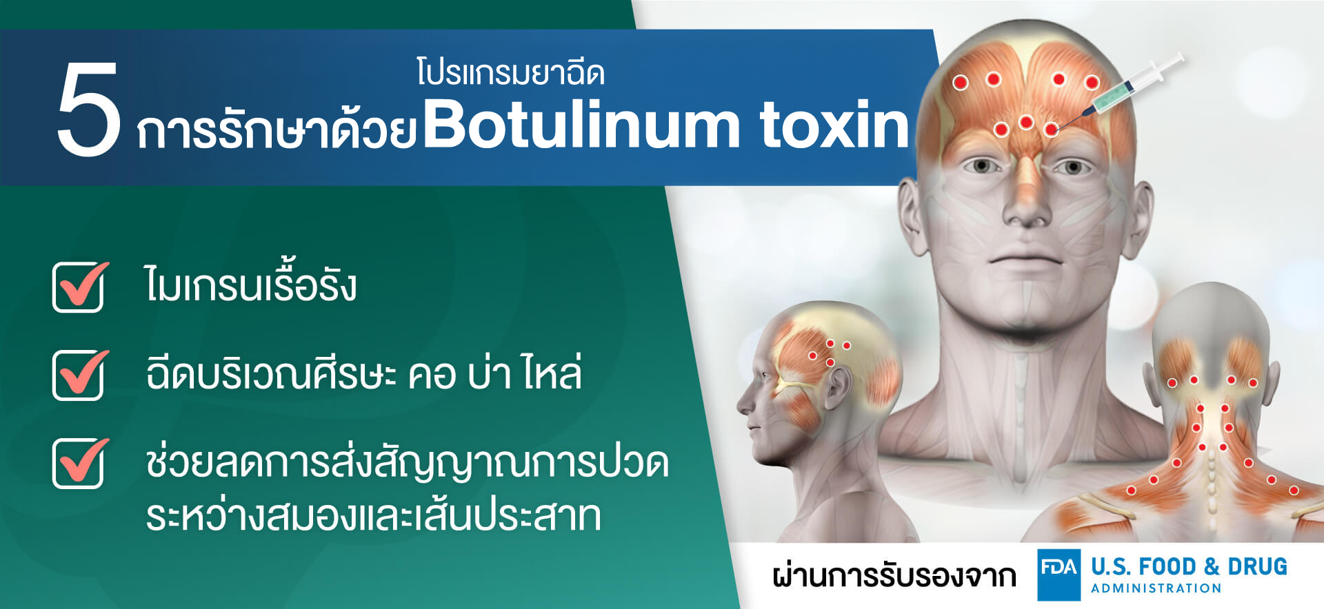 รักษาไมเกรนด้วยโปรแกรม Botulinum toxin